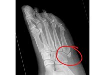 fracture_LI.jpg