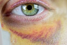 Eye Bruise (2).jpg