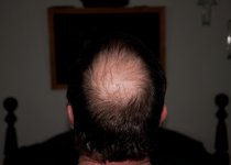 my-bald-head_9059.jpg